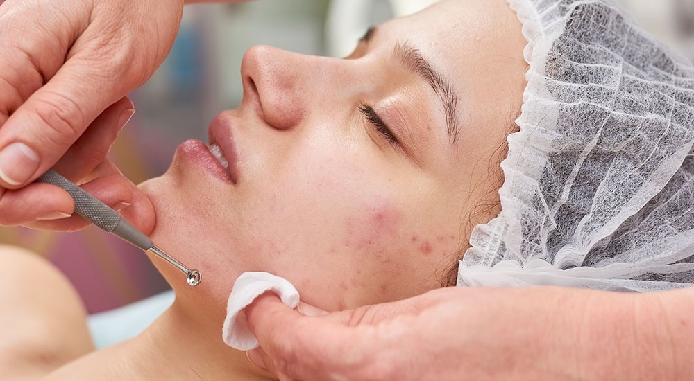 Microdermabrasion | Acne Treatment |Med Spa Kristals